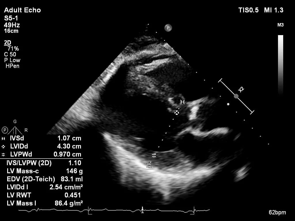 IVS, LVIDd, and LVPWd measurements